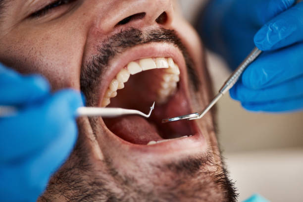 Best Emergency Wisdom Teeth Removal in Ankeny, IA